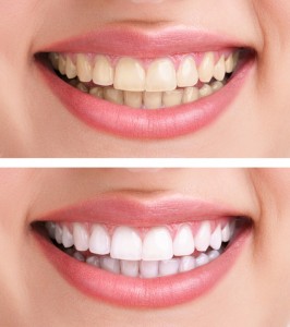 before and after teeth transition