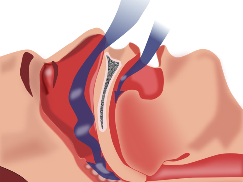 Featured image for “How Can My Dentist Help Me With Sleep Apnea?”