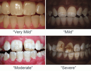 various degrees of dental damage