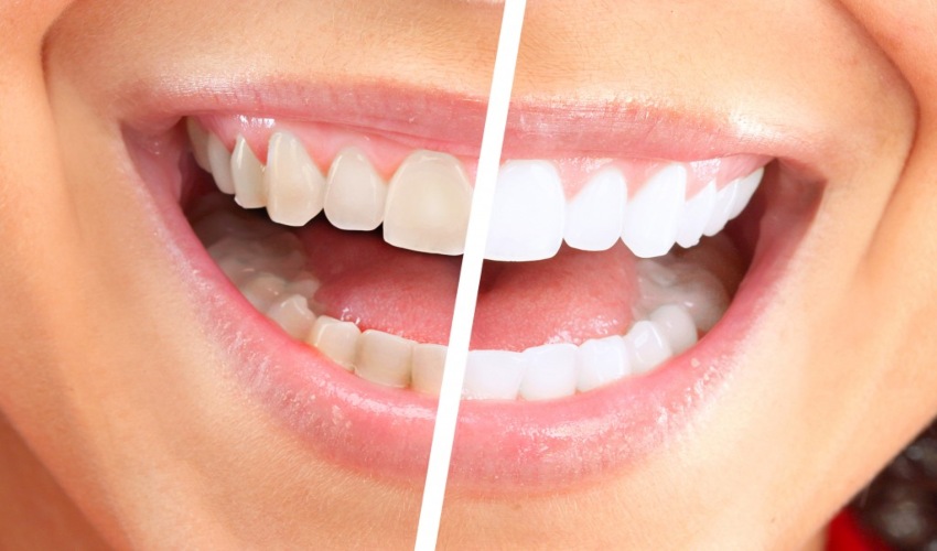 Teeth Whitening Treatment in Tempe, AZ