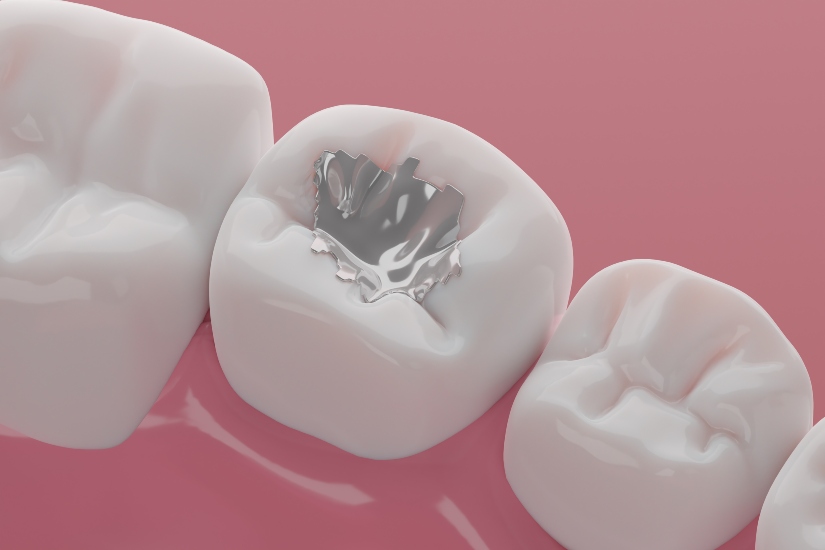 Featured image for “All About Silver Fillings”
