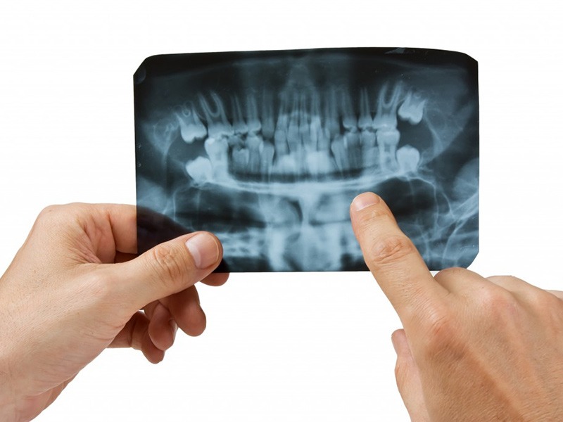 Featured image for “The Cost of Dental Implants”