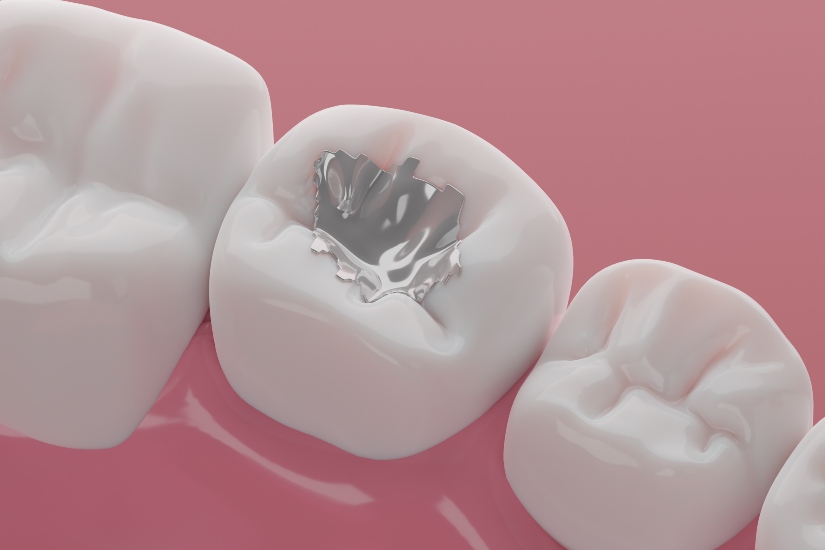 Silver Dental Fillings in Tempe, AZ